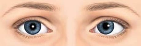 bansal-eye-hospital-squint-centre-left-convergent