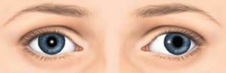 Left Divergent Squint