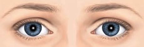 bansal-eye-hospital-squint-centre-normal-eyes